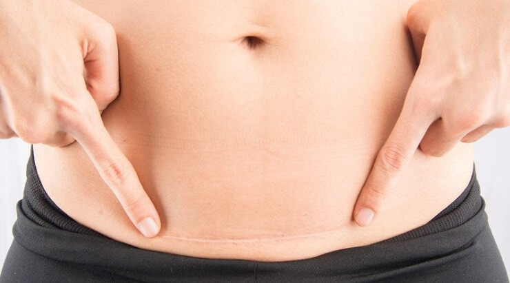 Chăm sóc vết mổ sau sinh mổ nhanh lành