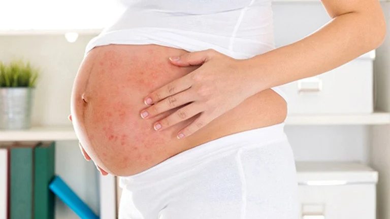 bà bầu bị dị ứng khi ăn cá