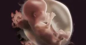 Đa ối là gì? Có nguy hiểm không và mẹ bầu cần làm gì để an toàn?