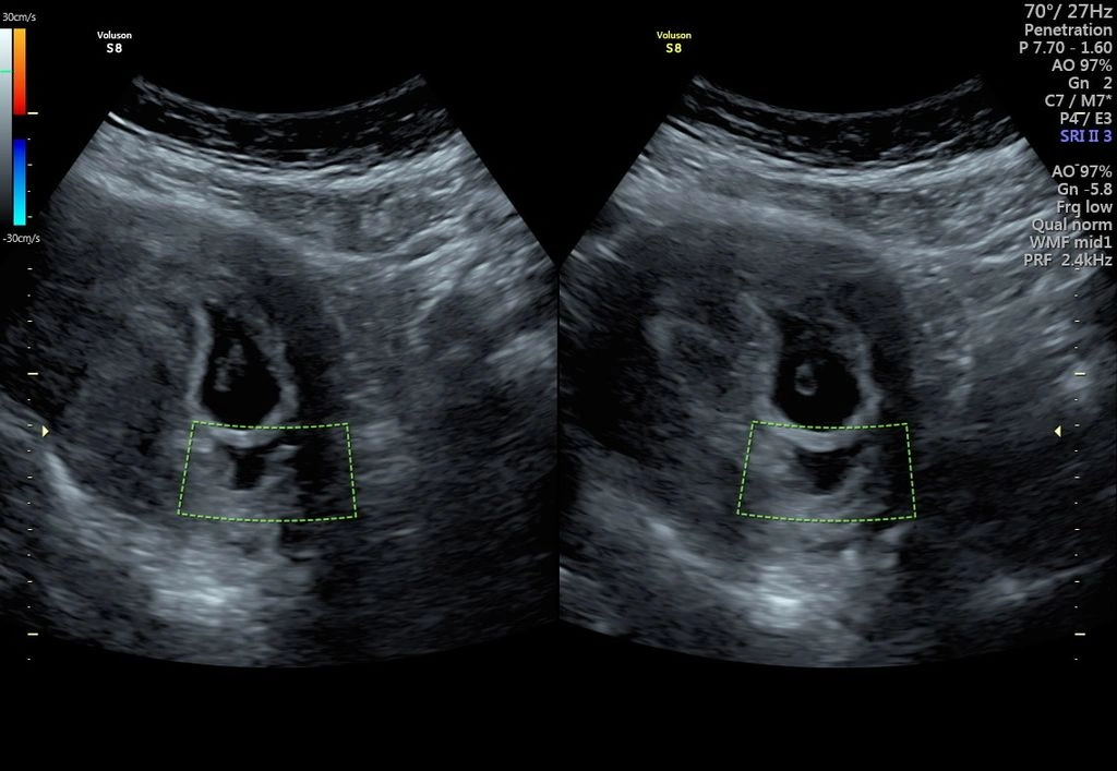 hình ảnh siêu âm của mẹ bầu thai 7 tuần