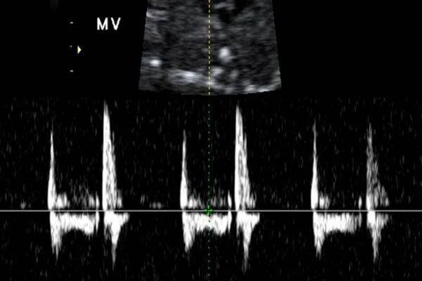 nhịp tim thai ổn định