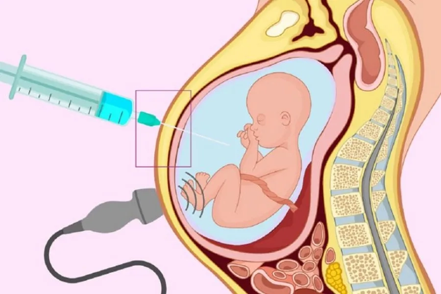 truyền ối khi bị thiếu ối